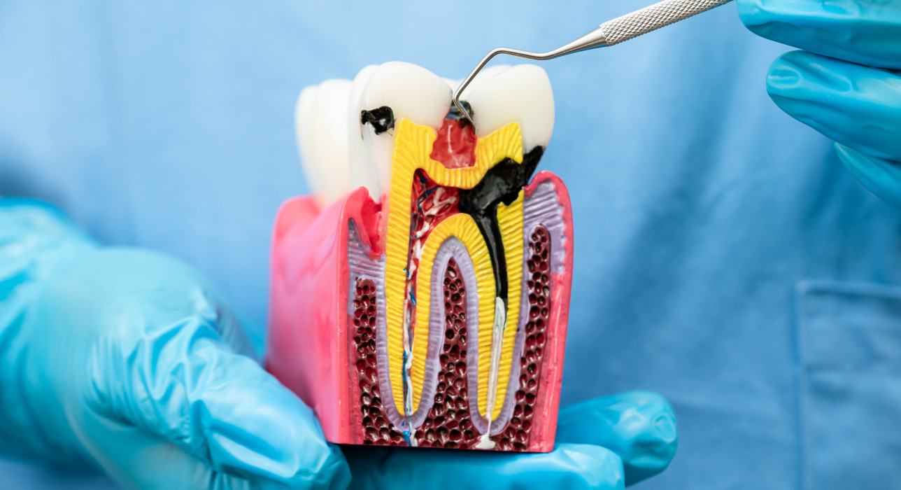 Dental Fillings
